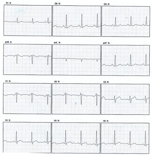 Paciente de 51 años portador de pectum excavatum que determina patrón rsr «trifásico» y onda P completamente negativa en  V1