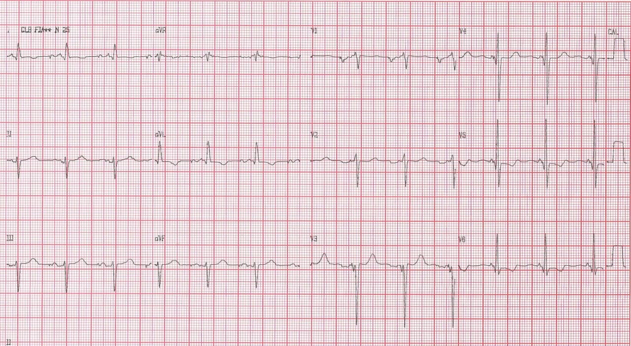 Paciente portador de miocardiopatía hipertrófica con CDI implantado que produce múltiples descargas espúreas por detectar episodios de FA originados en probable fibrosis auricular
