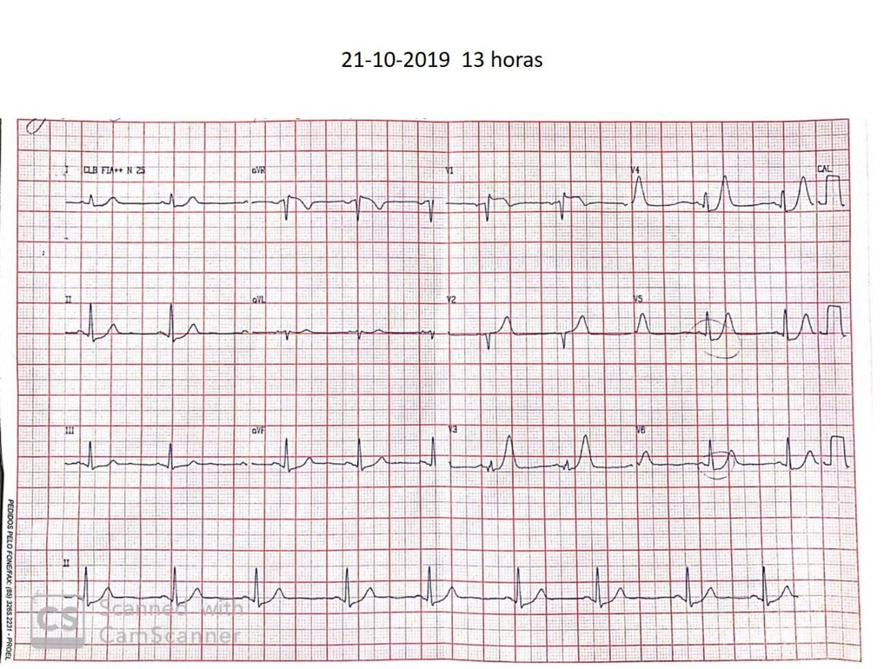 Hombre de 83 años con angor prolongado por suboclusión con trombo en la DA presentando patrón de Winter que desarrolla RIVA con tardío implante de stent