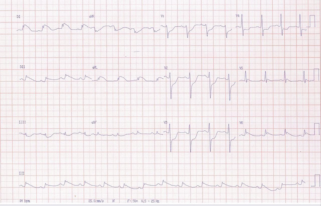 Paciente de 38 años que comienza con hemicranea y disartria agregándose luego dolor precordial y disnea cuyo ECG presenta signos de SCA ínfero lateral y cuya CCG mostró arterias coronarias normales y signos compatibles con síndrome de Takotsubo invertido o variante basal