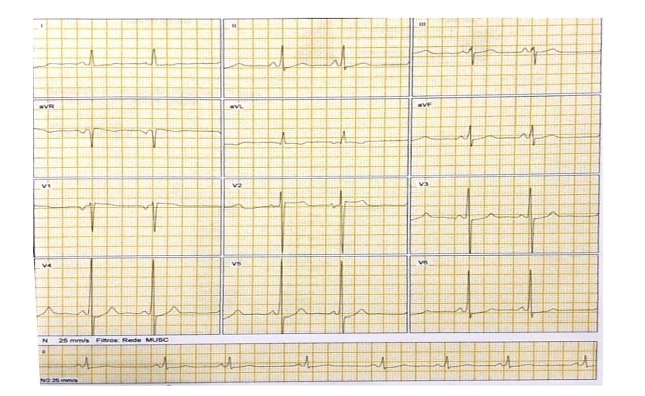 Mujer de 22 años con frecuentes episodios sincopales en quién se constata miocardiopatía hipertrófica y presencia de PR corto sin onda delta, con sospecha de enfermedad de Fabry