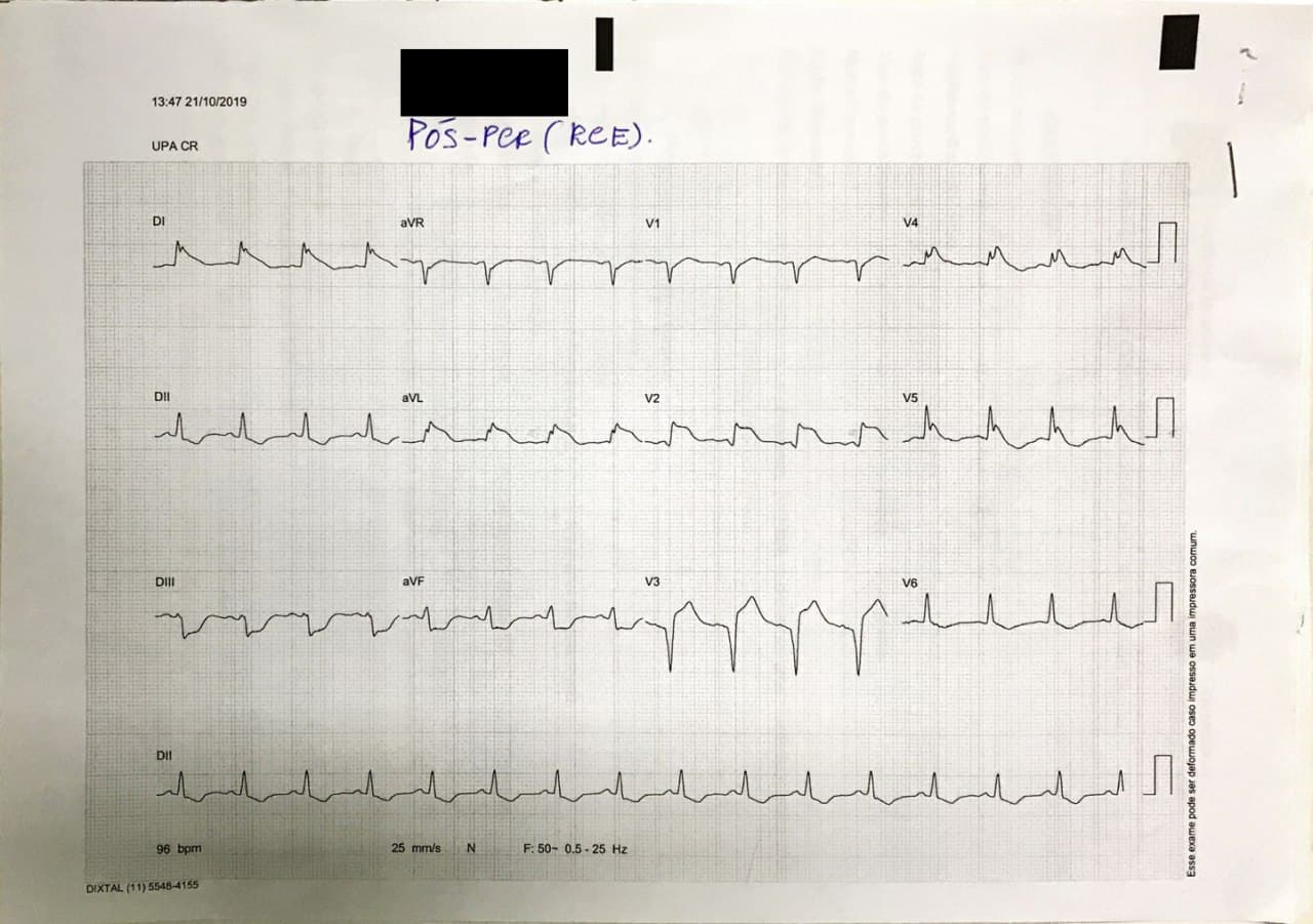 Hombre de 41 años con SCA que desarrolla FV siendo recuperado en quién se constata compromiso de la DA