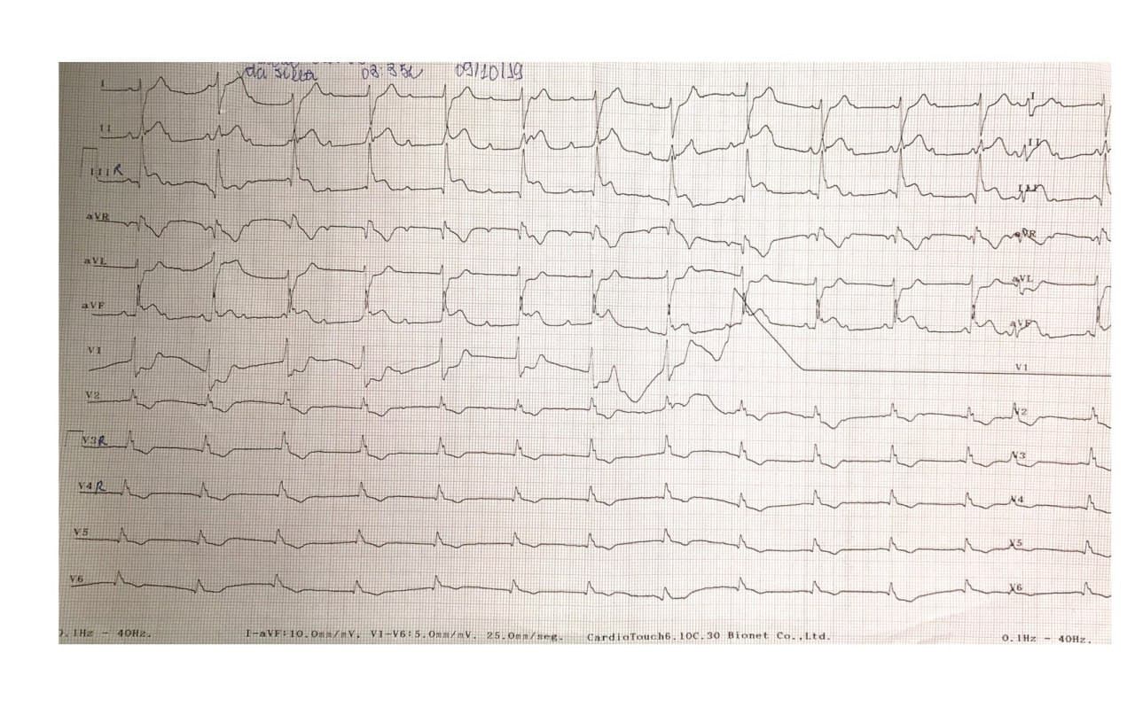 Paciente masculino de 66 años con antecedente inmediato de implante de stents a CD y Cx hace 20 días que decide suspender el clopidogrel y presenta angor prolongado constatándose trombosis en ambos con desarrollo de BAVC
