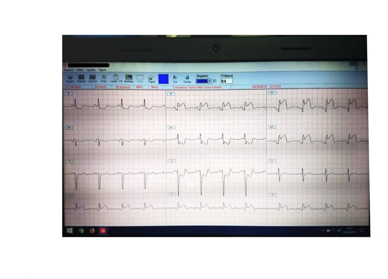 Paciente de 76 años que presenta angor prolongado por SCA que compromete aurícula por oclusión de CD proximal