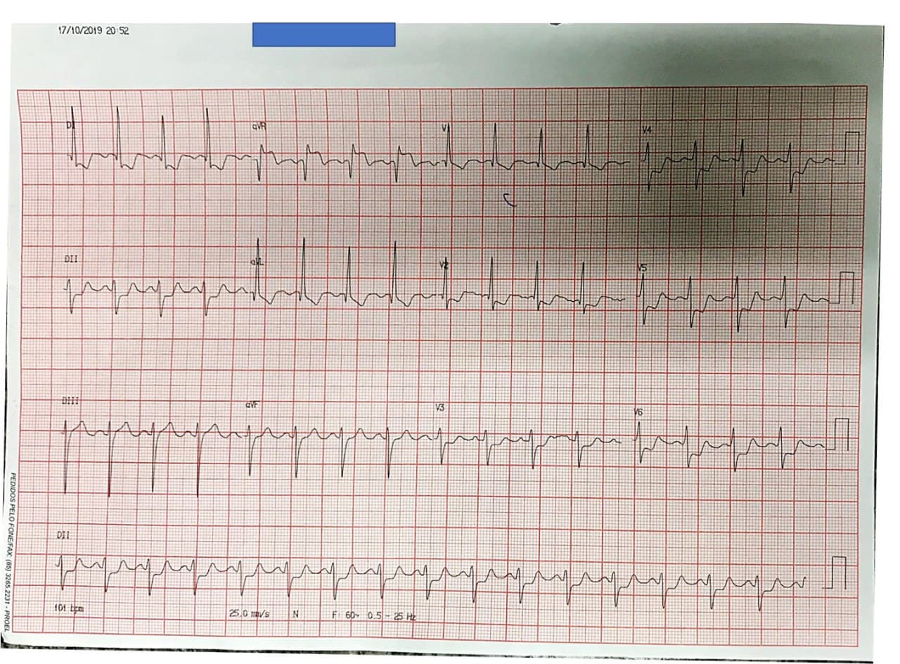 Mujer de 42 años tabaquista crónica que presenta angor progresivo con episodios de reposo por suboclusión ostial de tronco de coronaria izquierda