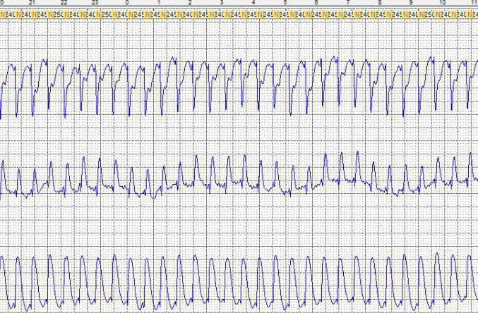 Trazado de Holter de paciente que presenta aleteo auricular 1:1