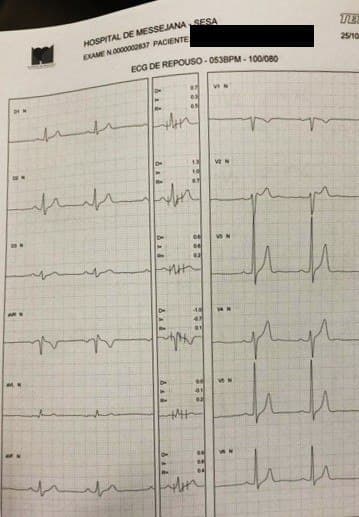 Paciente asintomático de 33 años que desarrolla patrón de Brugada durante la recuperación de test ergométrico