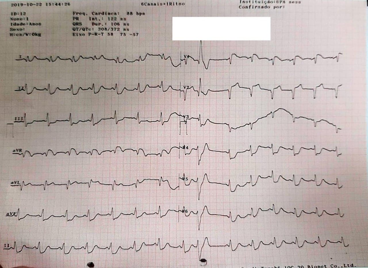 Hombre de 29 años consumidor de drogas ilícitas, con antecedente de IAM previo que presenta angor prolongado cuya CCG muestra oclusión total de la DA  intratent + Cx por la presencia de trombo