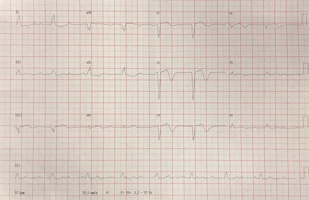 Mujer de 39 años que en 2018 presenta neoplasia de útero siendo tratada con quimio y radioterapia detectándose a posteriori BAVC y presencia de masas ecográficas con sospecha de metástasis cardíacas