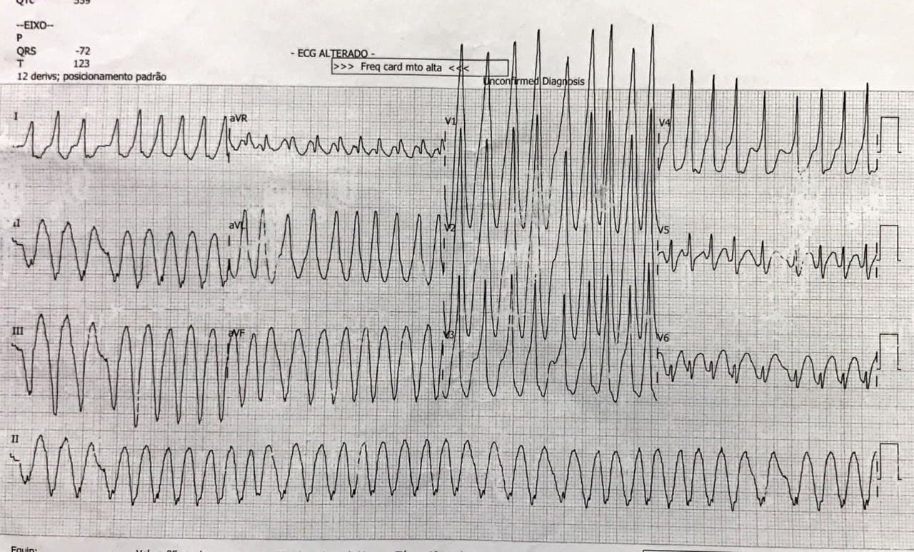Paciente de 36 años que presenta FA preexcitada requiriendo CVE que permite observar una onda delta que simula ser Q en cara inferior