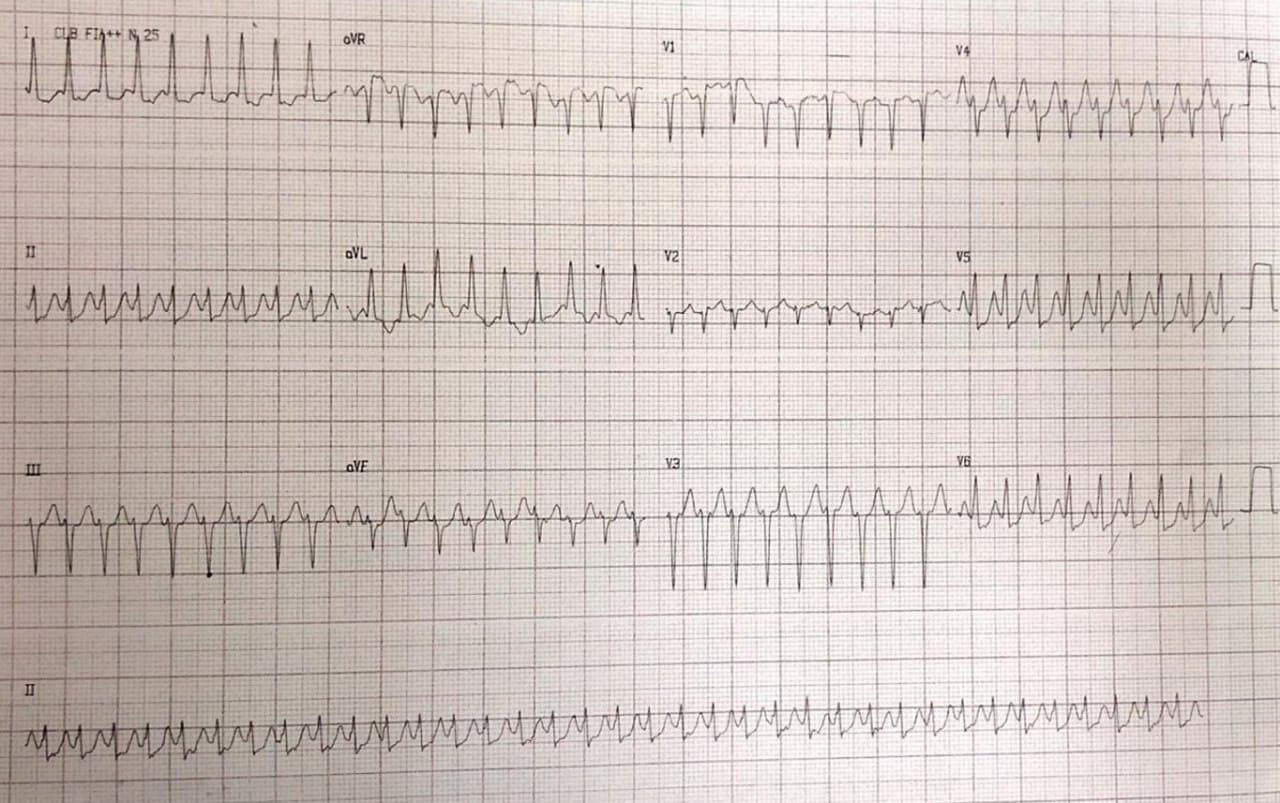 Paciente de 67 años con palpitaciones que presenta taquicardia de QRS angosto en el que la adenosina permite visualizar mínima preexcitación