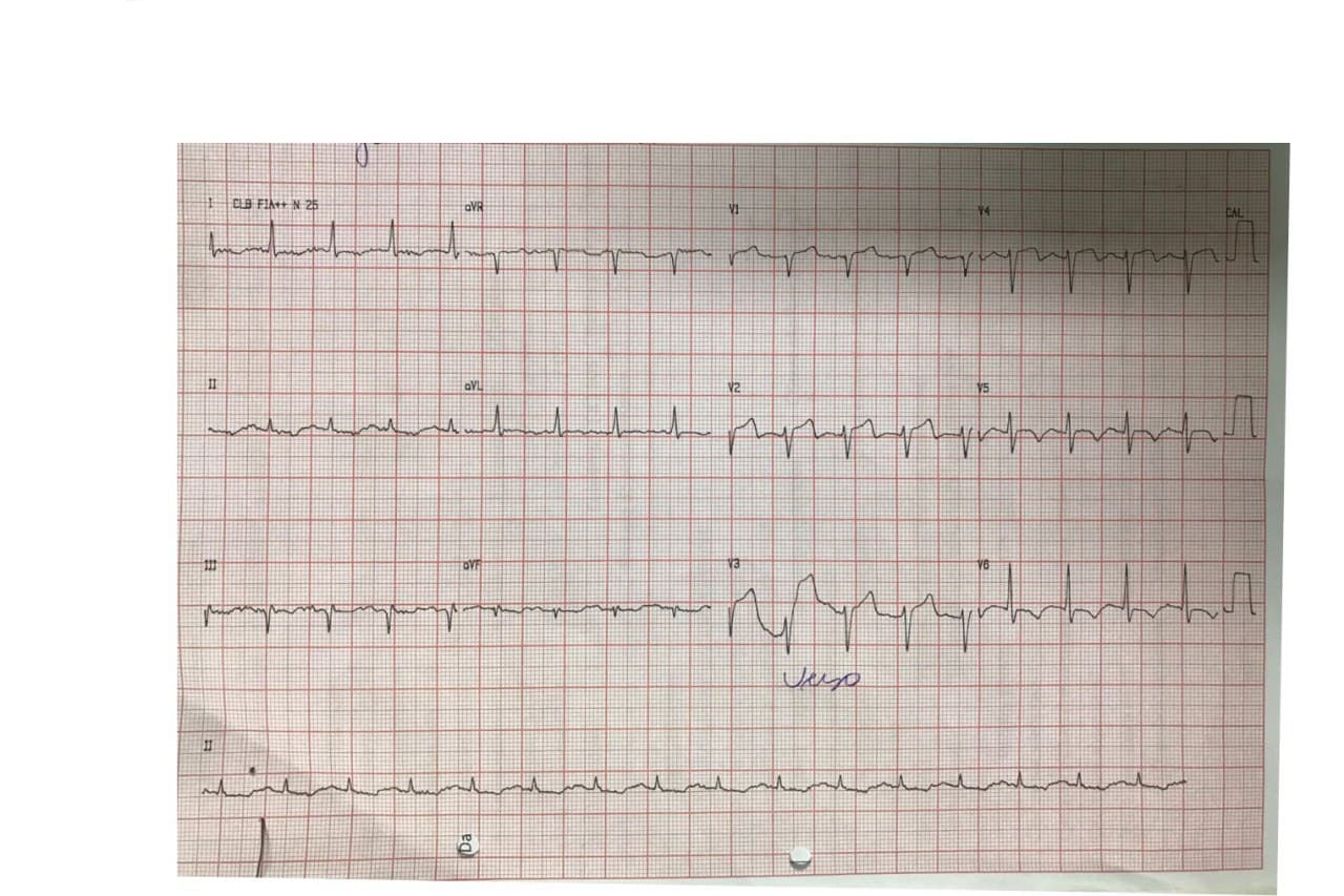 Paciente sometido a terapia trombolítica prehospitalaria con tenecteplase con marcada mejoría del angor al cabo de una hora constatándose en la CCG suboclusión de la DA