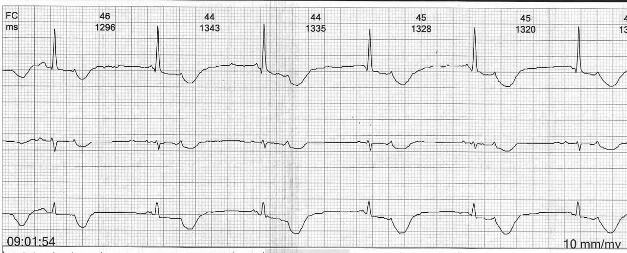 Paciente de 73 años cursando proceso séptico tratado con antibióticos y antifúngicos que presenta SQTL y bigeminismo extrasistólico desencadenándose a posteriori TA con alto grado de BAV