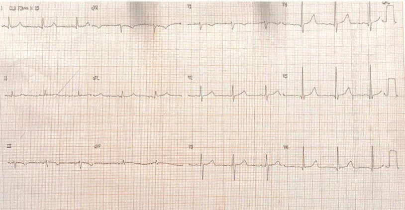 Hombre fumador de 78 años que presenta dolor toráccico desde hace una semana debido a síndrome aórtico agudo por hematoma intramural