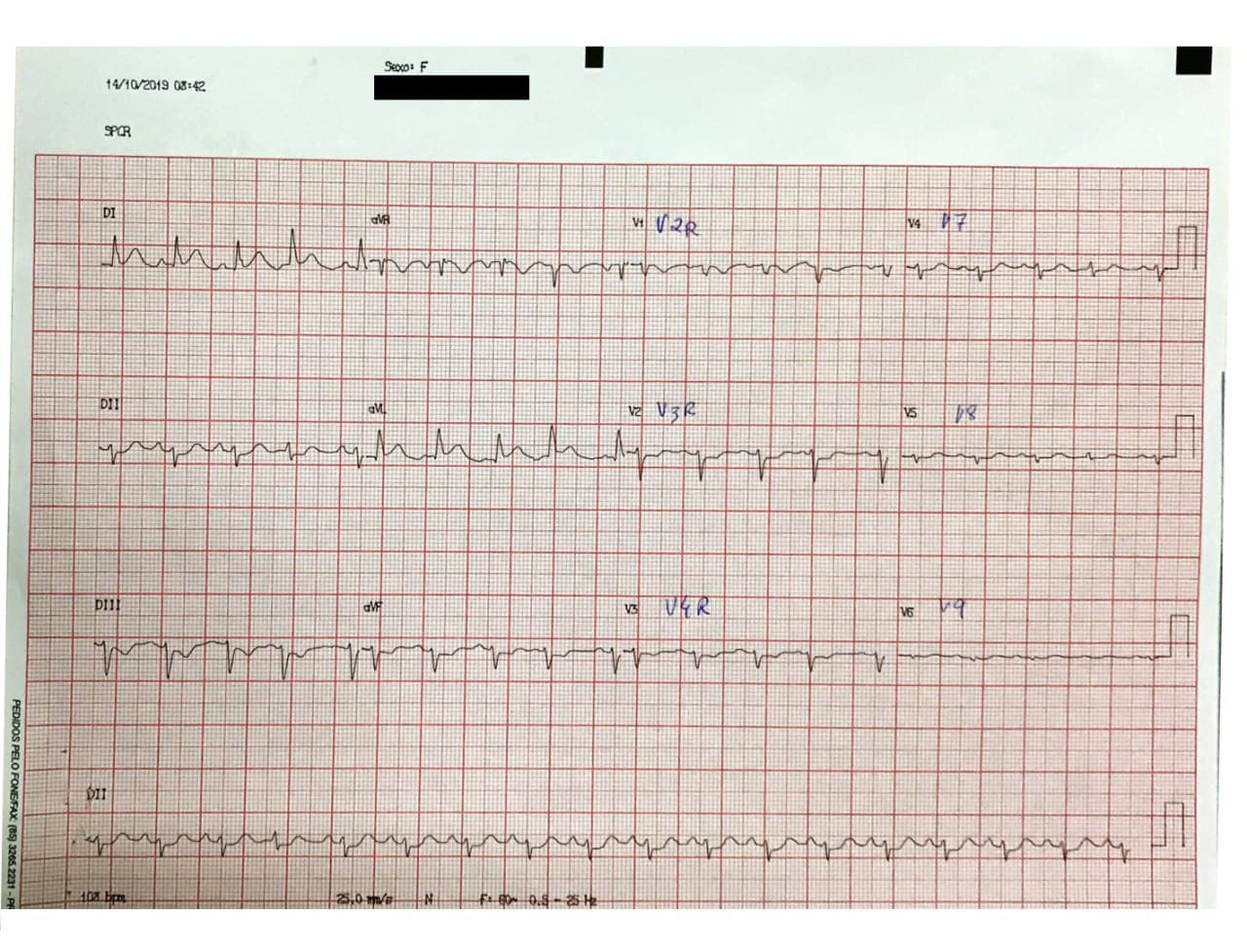 Mujer de 82 años hipertensa cursando IAM por compromiso de la arteria marginal de la Cx