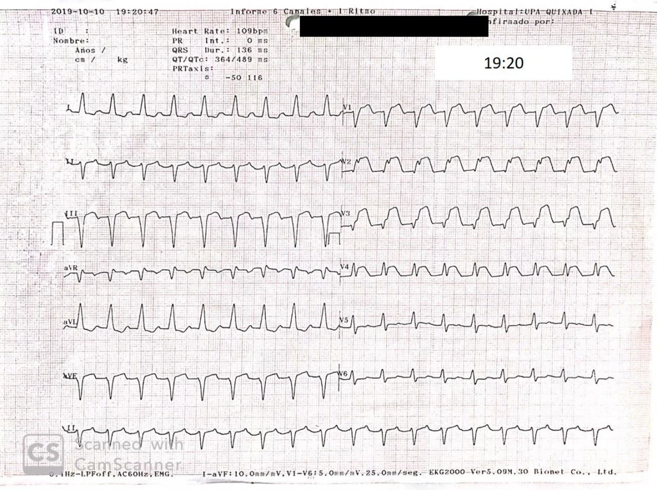 Hombre de 84 años con episodio de angor prolongado por compromiso de la DA, con presencia de bloqueo trifascicular practicándose angioplastia con implante de stent y desarrollo ulterior de BAV de alto grado con restauración del flujo de la DA, pero con oclusión de la rama septal y Dg 1