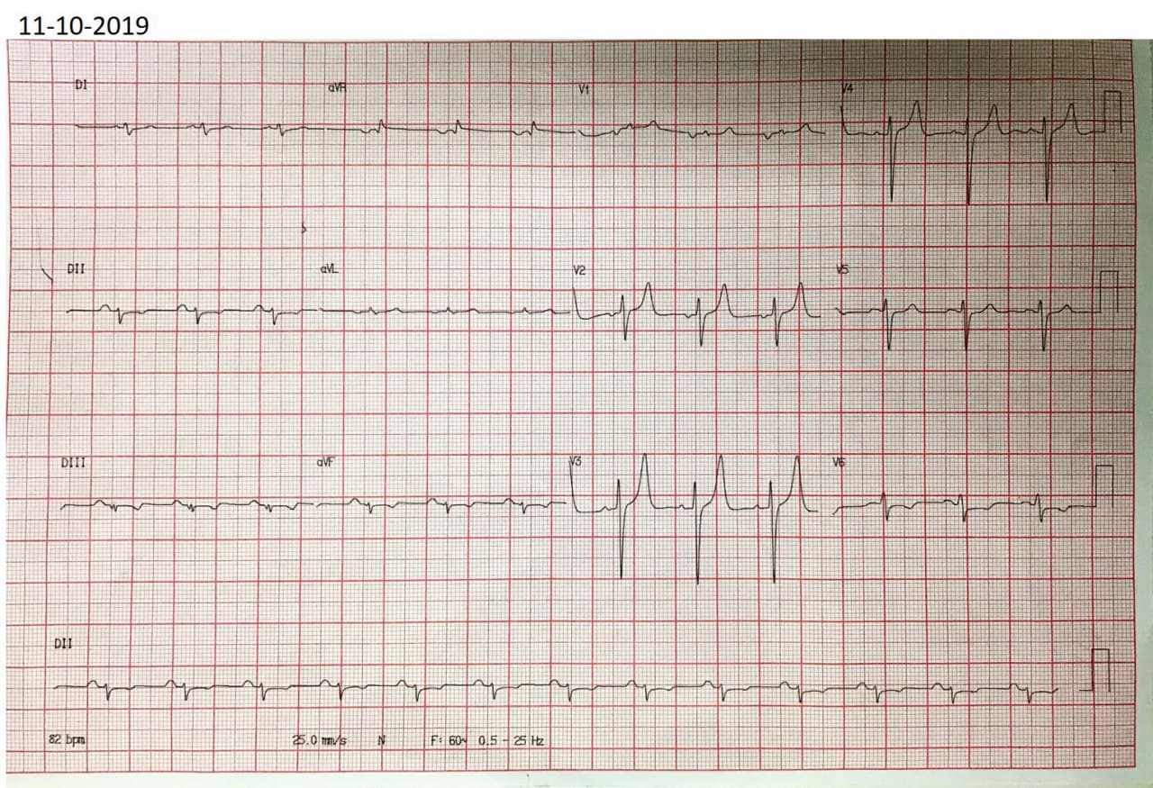 Hombre de 44 años con antecedente de IAM hace 6 meses con implante de stent a la DA que presenta epigastralgia ante esfuerzos desde hace tres días por nuevo compromiso de Cx que presenta complejos de bajo voljaje en derivaciones de los miembros como expresión de miocardiopatía isquémica