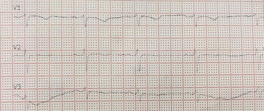Mujer de 33 años portadora de SQTL con CDI implantado que presenta episodio sincopal que corresponde a TV polimorfa que evoluciona a FV, detectadas por el dispositivo