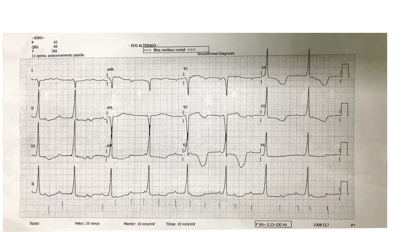 Mujer de 39 años tratada con gabapentina y amitriptilina que presenta BAVC + SQTL a quién se implanta  MP