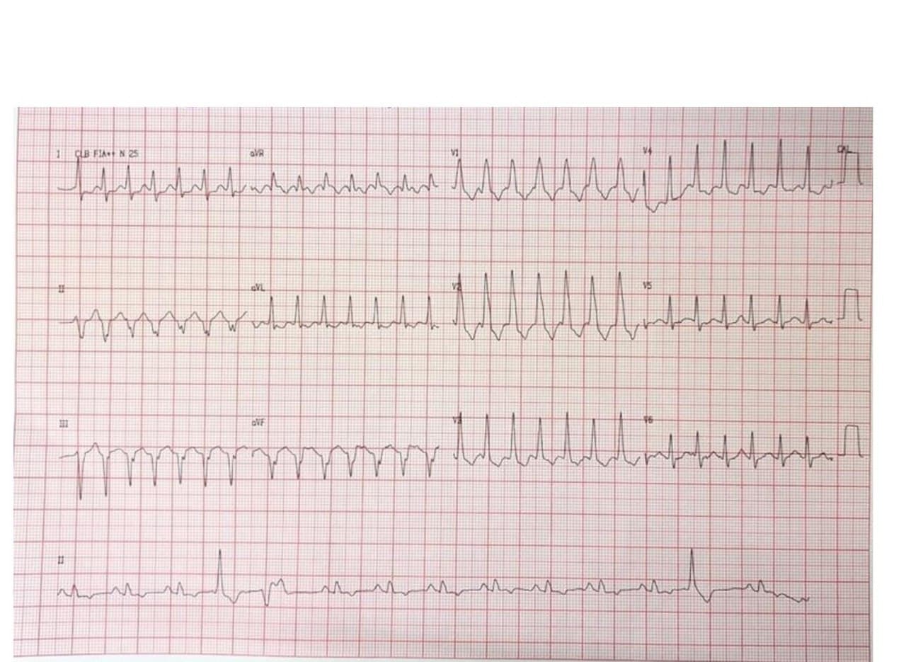 Mujer de 72 años HTA DBT y dispipemia, con antecedente de iAM previo y ACV que manifista palpitaciones por presentar una TV fascicular posterior (de Belhassen)