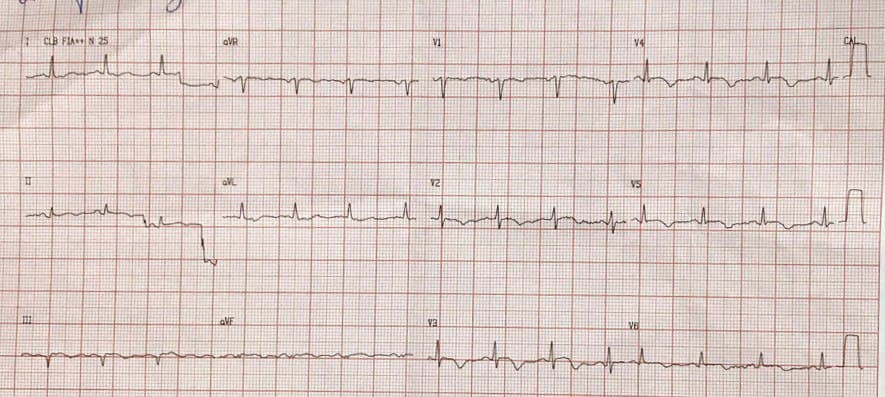 Mujer de 65 años con factores de riesgo que presenta episodio de angor prolongado por suboclusión de la DA configurando un síndrome de Wellens tipo II