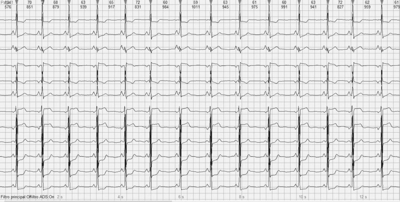 Mujer de 22 años portadora de miocardiopatía hipertrófica no obstructiva con antecedentes de MS familiar