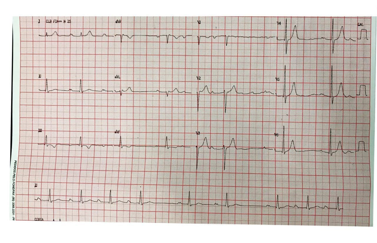 Varón de 22 años con palpitaciones que presenta soplo de insuficiencia mitral y que desarrolla TV sostenida y no sostenida cuya RNM demostró presencia de miocarditis activa
