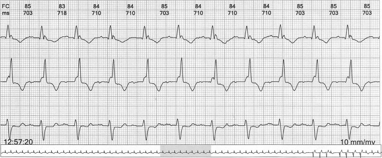 Paciente de 70 años con antecedente reciente de SCA e implante de stent que reingresa con BAV que requiere colocación de MP transitorio y ulterior desarrollo de TV polimorfa y FV irreversibles