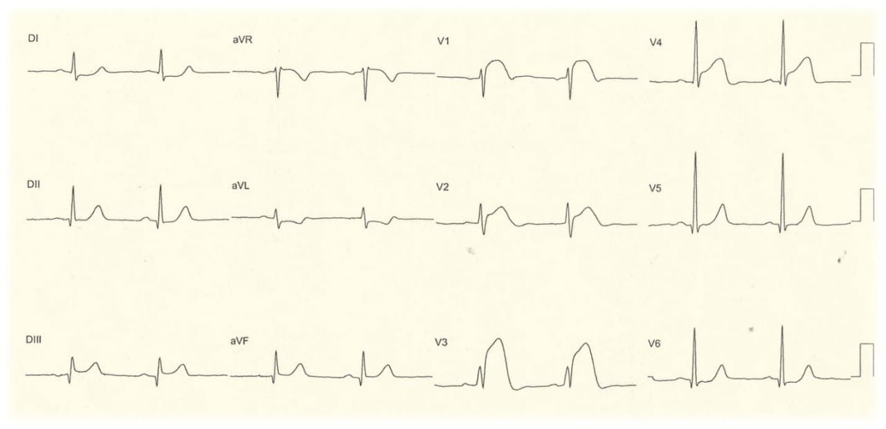 Paciente con infarto de VD por compromiso de la arteria CD