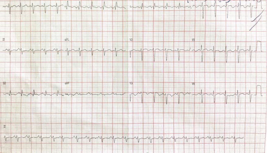 Paciente de 51 años que presenta disnea progresiva por TEP múltiple bilateral con patrón S1Q3T3