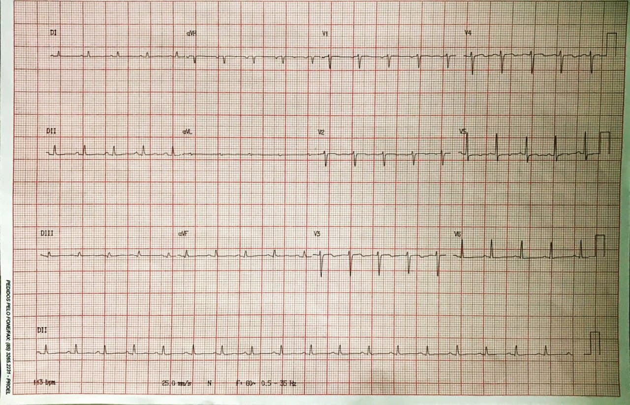 Mujer de 56 años mastectomizada hace 5 años, asintomática, con derrame pericárdico severo crónico de lenta progresión