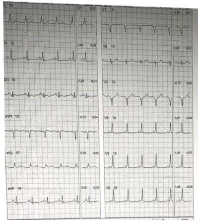 Varón de 18 años que presenta preexcitación y que al someterse a una prueba de esfuerzo bloquea la vía accesoria lo cual se interpreta como señal de bajo riesgo