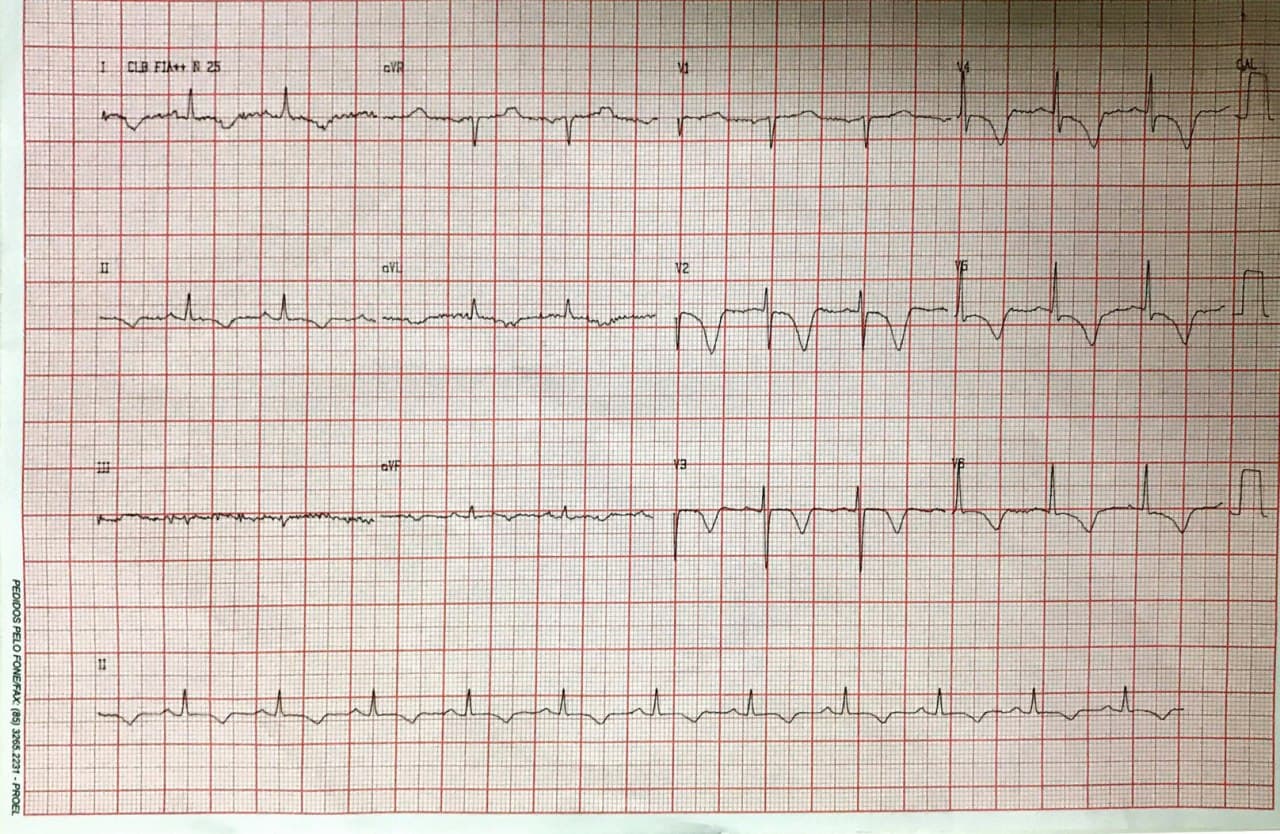 Mujer de 84 años que presenta episodio de angor prolongado con ondas T negativas difusas por presencia de tortuosidades coronarias