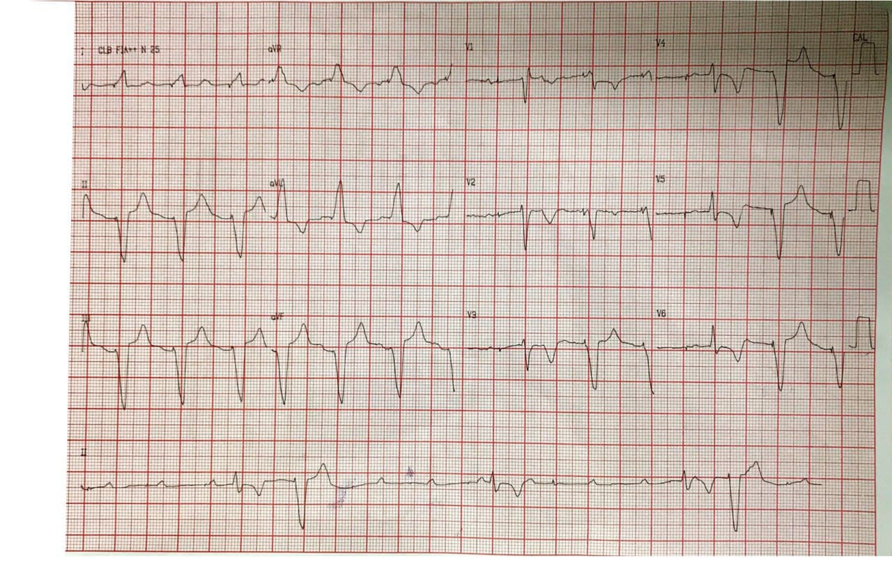 Mujer de 57 años que presenta episodio sincopal por BAVC que requiere implante de MP transitorio, constatándose ondas T negativas como expresión de memoria cardíaca y presencia de arterias coronarias normales en la CCG