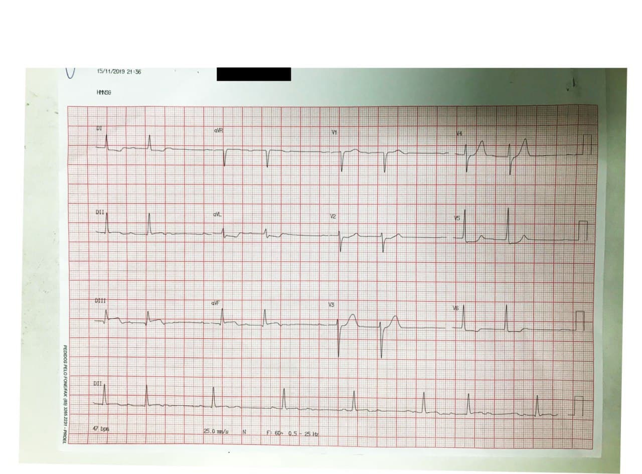 Mujer de 77 años con factores de riesgo que presenta angor prolongado por compromiso de CD en tercio medio que determina BAV 2:1 alternando con Tipo 1 o Mobitz I