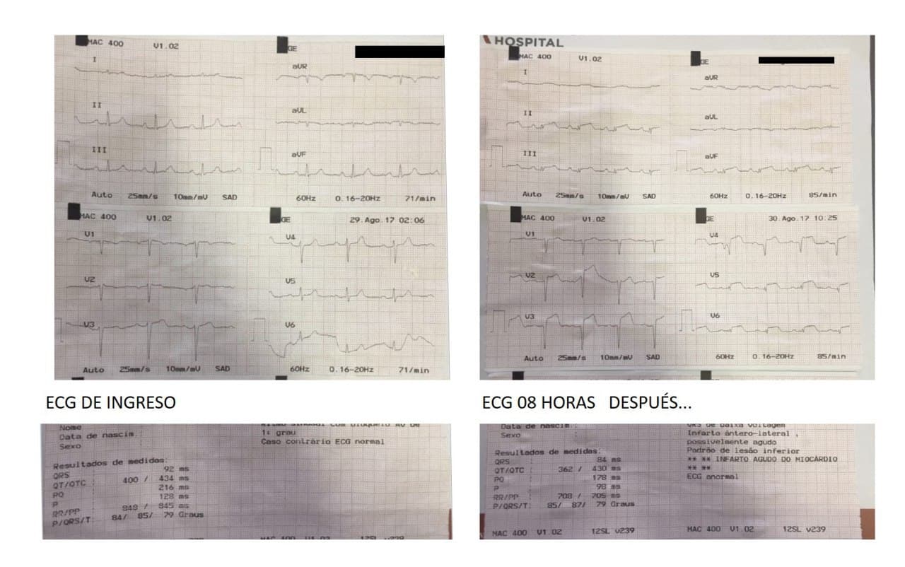 Mujer de 71 años que entra en coma luego de caer por una escalera por presencia de hemorrragia subaracnoidea derecha, sospechándose presencia de síndrome de Tako Tsubo