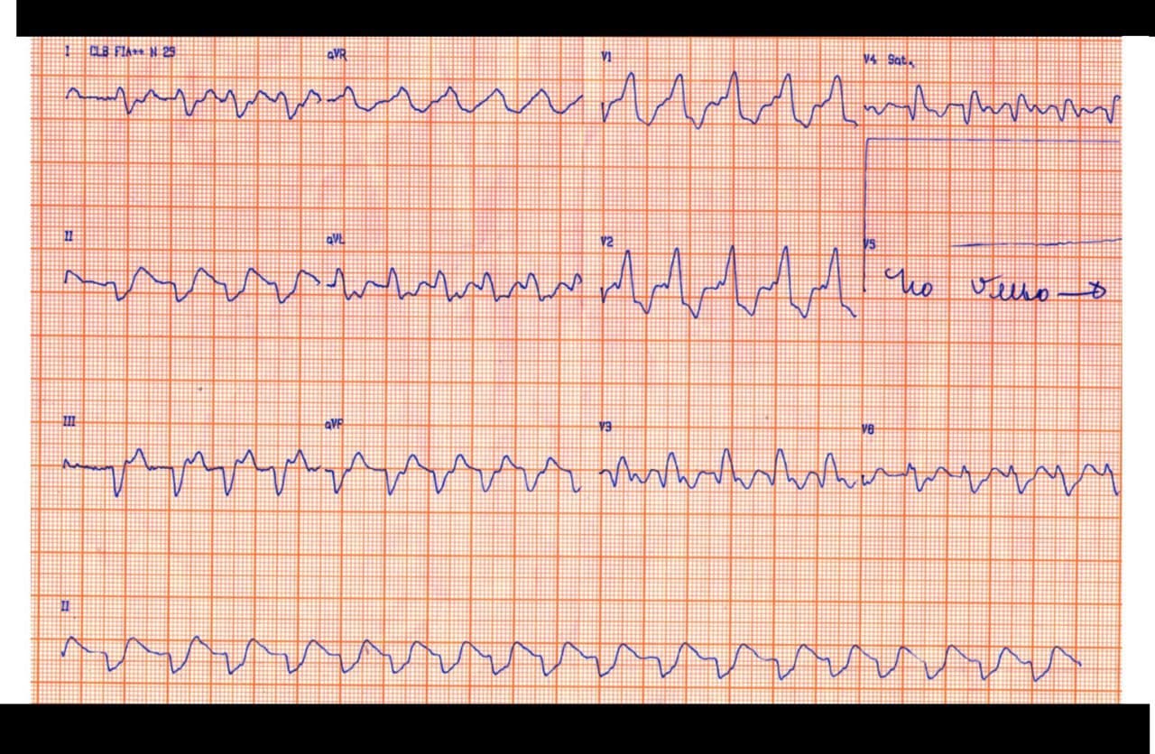 Paciente con cuadro de insuficiencia cardíaca cuyo ECG presenta una FA con BCRD muy ancho debido a franca hiperkalemia que mejora con tratamiento