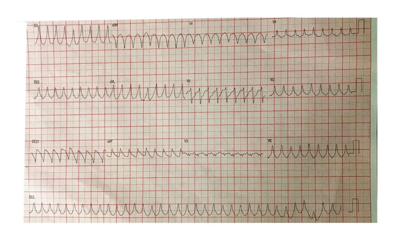Mujer de 51 años con factores de riesgo y antecedente de implante de stent a CD hace 5 años que presenta TVMS originada en cuadrantes 9 – 10