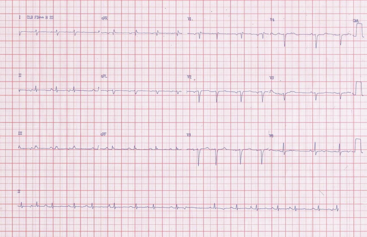 Paciente portador de EPOC con cuadro de insuficiencia respiratoria que presenta ritmo auricular caótico o multifocal