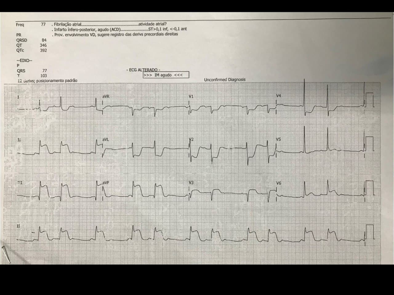 Paciente masculino de 56 años con factores de riesgo que presenta episodio de ángor prolongado por lesión de CD con presencia de trombo que determina BAV de 2º grado Mobitz 1