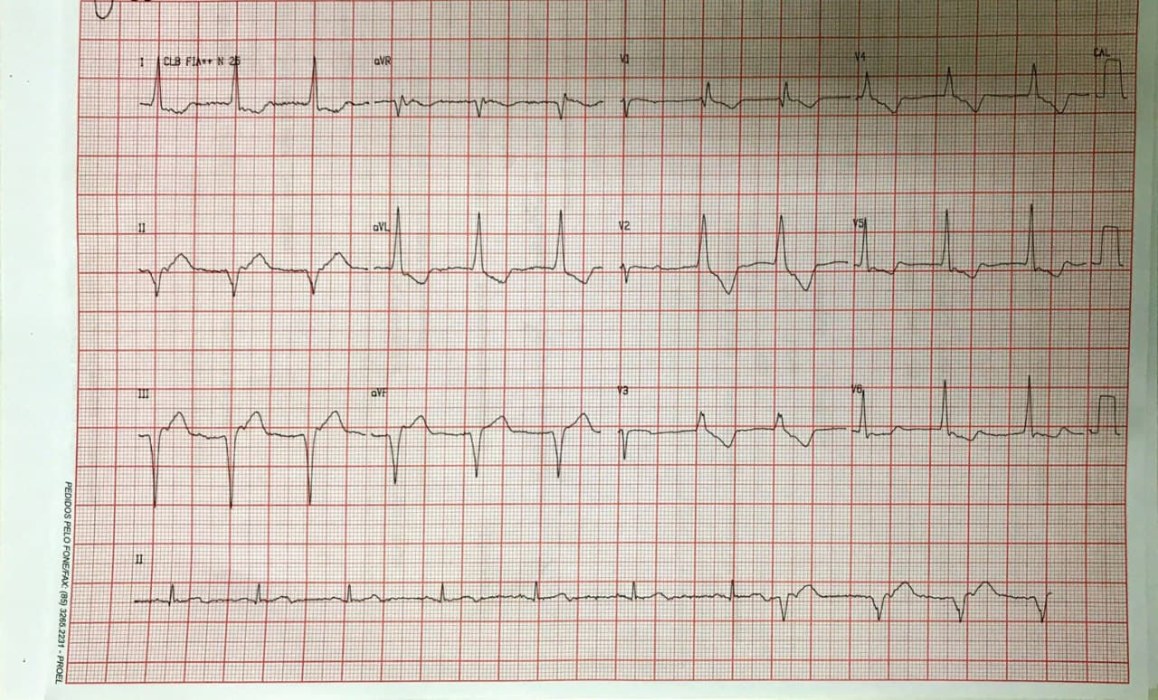 Paciente masculino con factores de riesgo que presenta angor prolongado por SCA con reperfusión espontánea incompleta manisfestada por RIVA + ondas T +- en DII