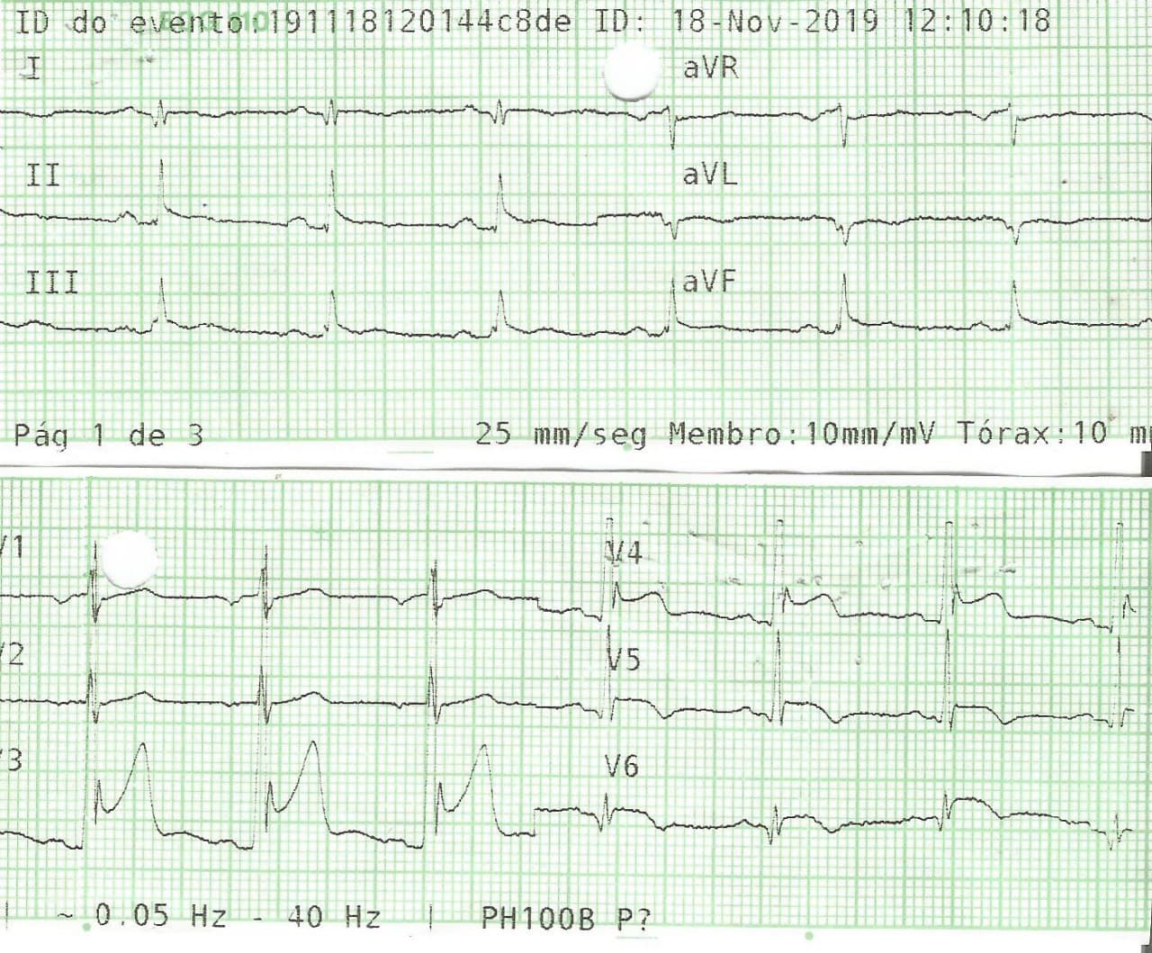 Paciente fumador de 71 años que presenta desde hace varios días dolor precordial de carácter inspiratorio que hace sospechar pericarditis y que sin embargo se trata de un SCA por compromiso de Cx