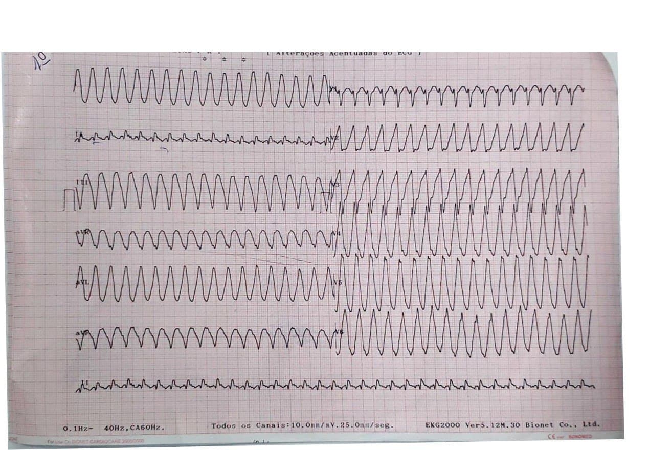 Paciente de 66 años con antecedentes de insuficiencia cardíaca que presenta palpitaciones, sudoración, vómitos e inestabilidad hemodinámica por presencia de aleteo auricular 1:1