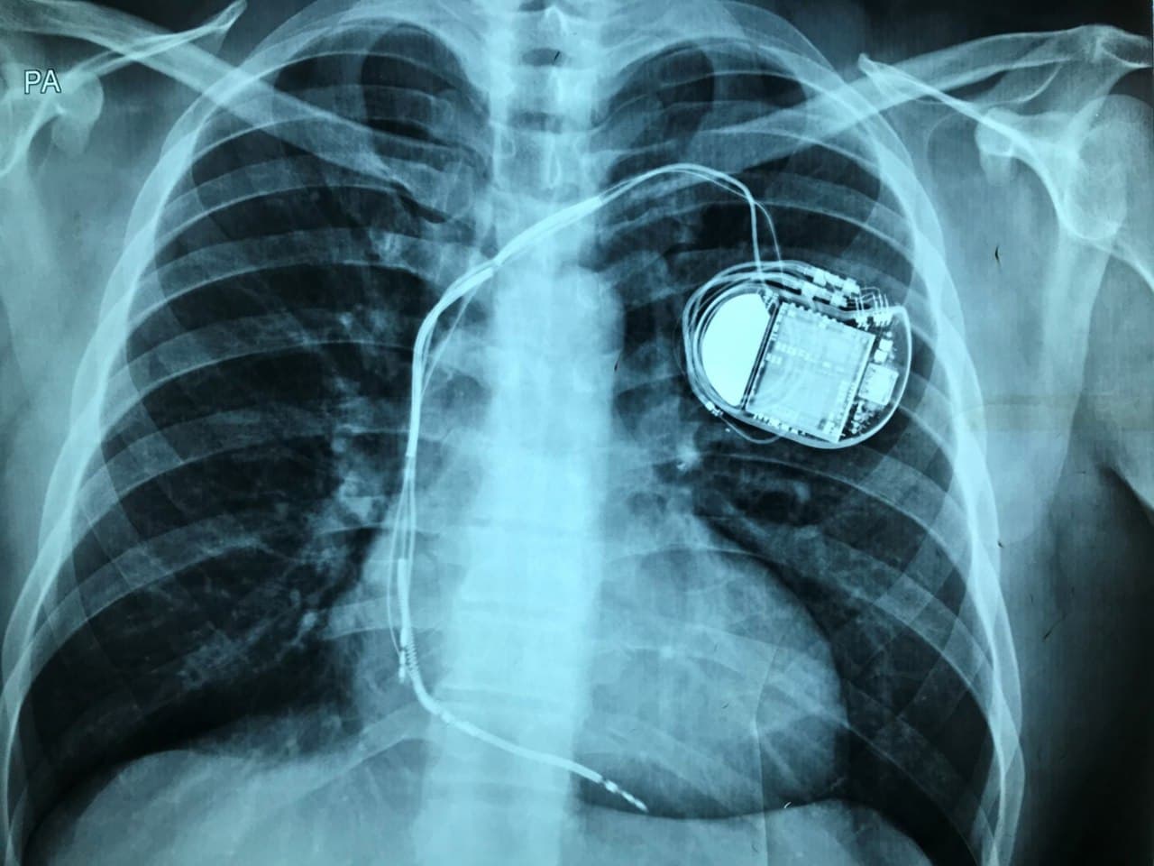 Paciente afectado de miocardiopatía hipertrófica portador de CDI que presenta múltiples descargas del dispositivo por fractura del electrodo