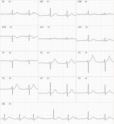 Niña de 15 años sin cardiopatia estructural, con episodios sincopales por presencia de BAVC en contexto de SQTL