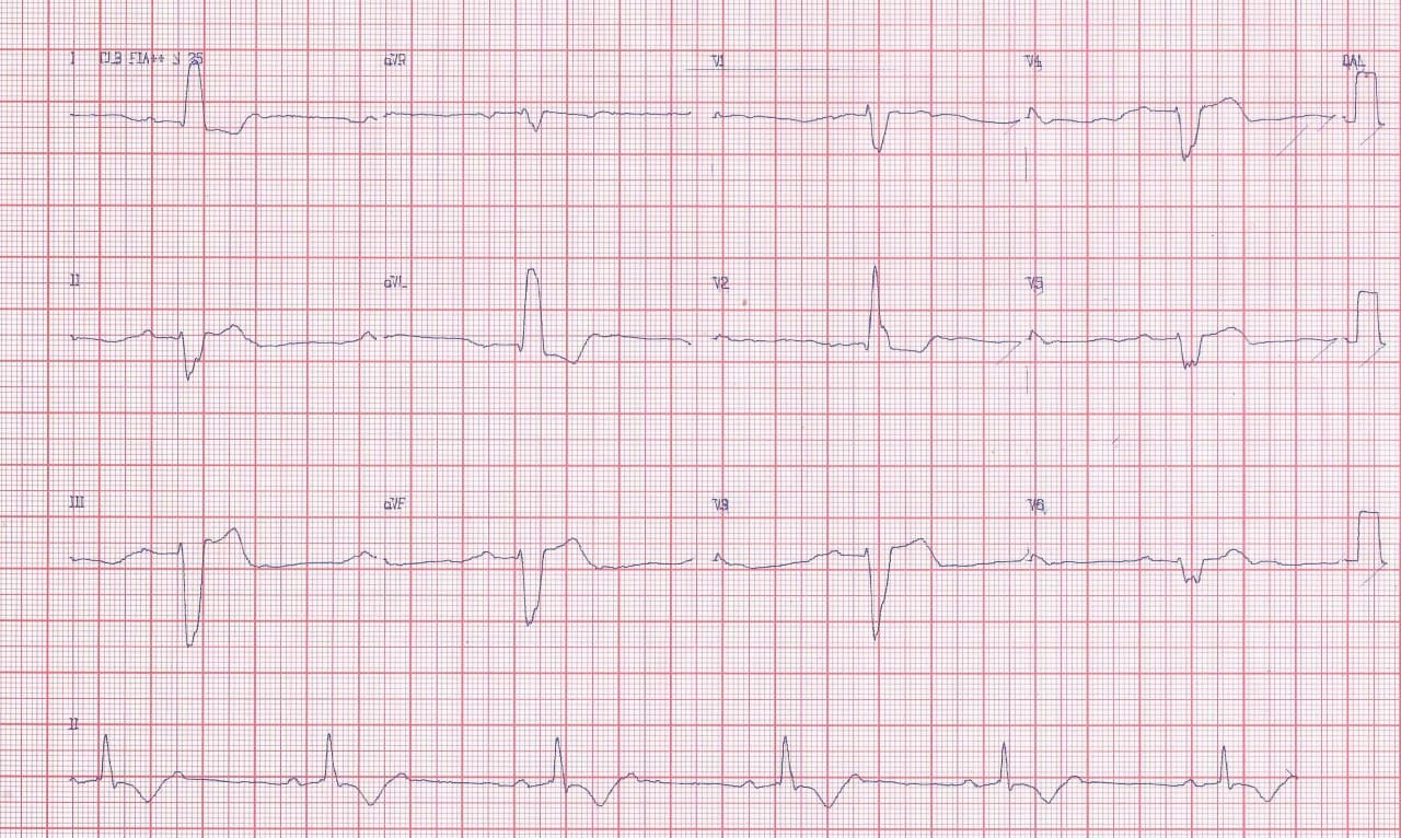 Mujer de 42 años con debilidad en MMII portadora de Enfermedad de Steinert que presenta severo trastorno de conducción