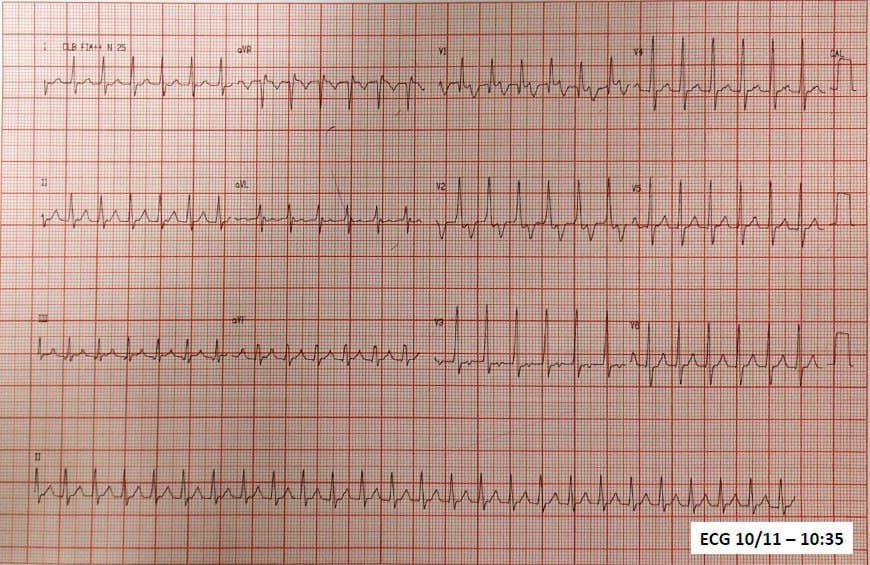 Paciente masculino de 25 años con palpitaciones incesantes desde hace 4 días por presencia de Taquicardia Auricular que revierte con adenosina quedando por momento con TA con BAV variable