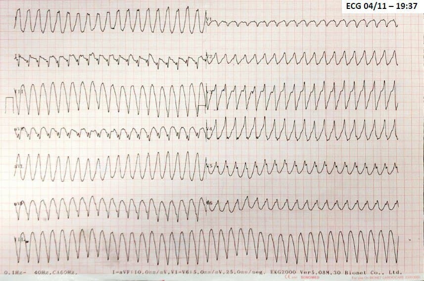 Paciente masculino de 57 años que presenta angor prolongado, disnea y palpitaciones por presentar TV originada en territorio de la CD dominante y ocluida totalmente en región proximal