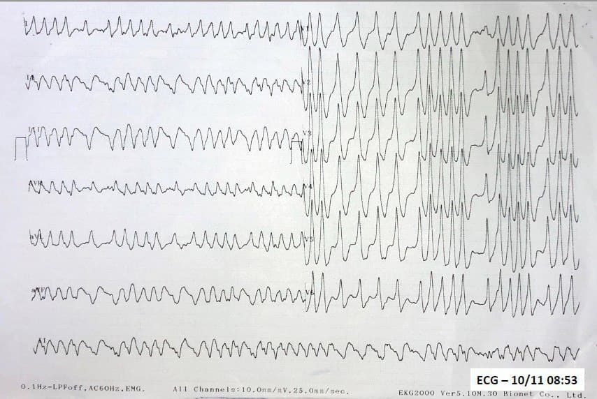 Paciente masculino de 57 años con palpitaciones, astenia, disnea y dolor precordial que presenta FA preexcitada por vía anómala posterior izquierda que es cardiovertida
