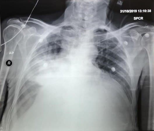 Paciente de 69 años con disnea y tos productiva que desarrolla edemas de MMII por presencia de derrame pericárdico hemático neoplásico